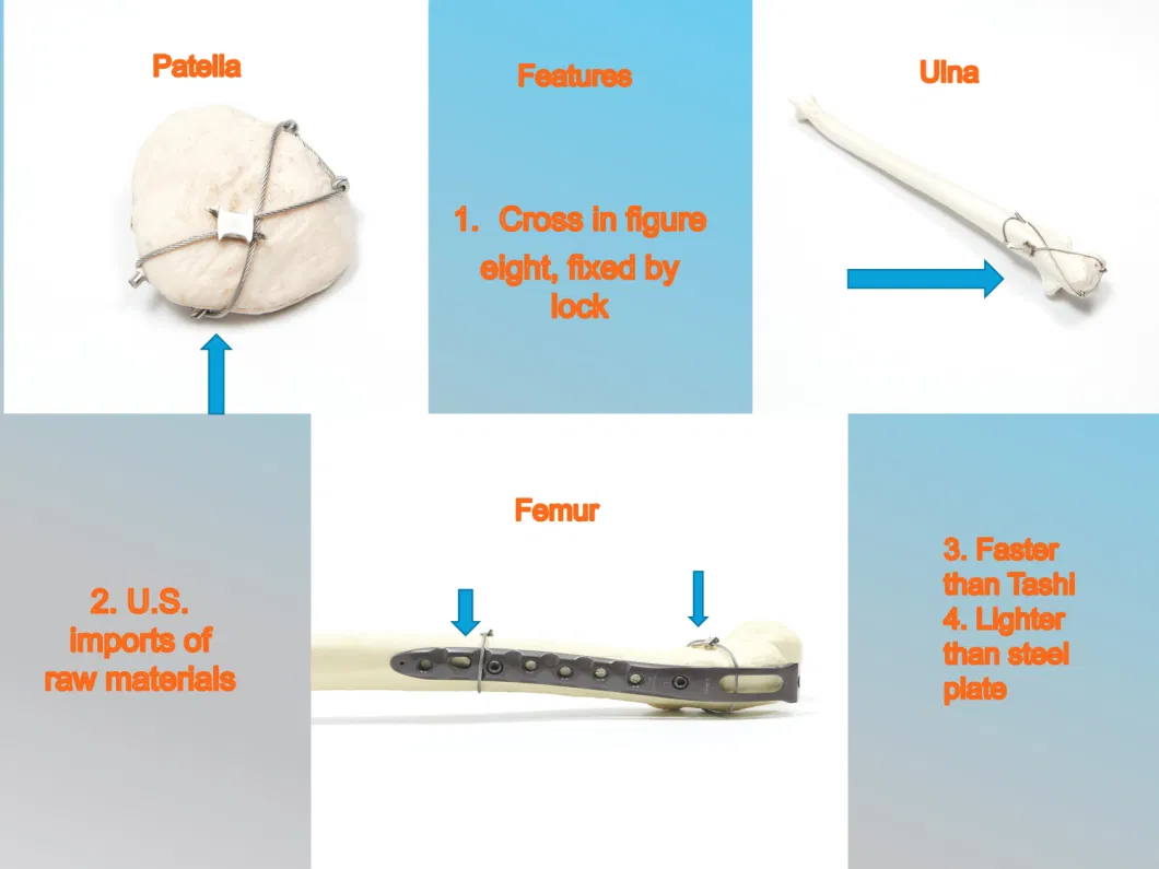 Orthopedic Implant Titanium Wire (Cable Grip) for Patella, Ulna, Femur